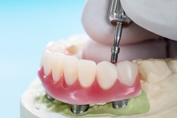 Comparing Implant Supported Dentures With Traditional Dentures